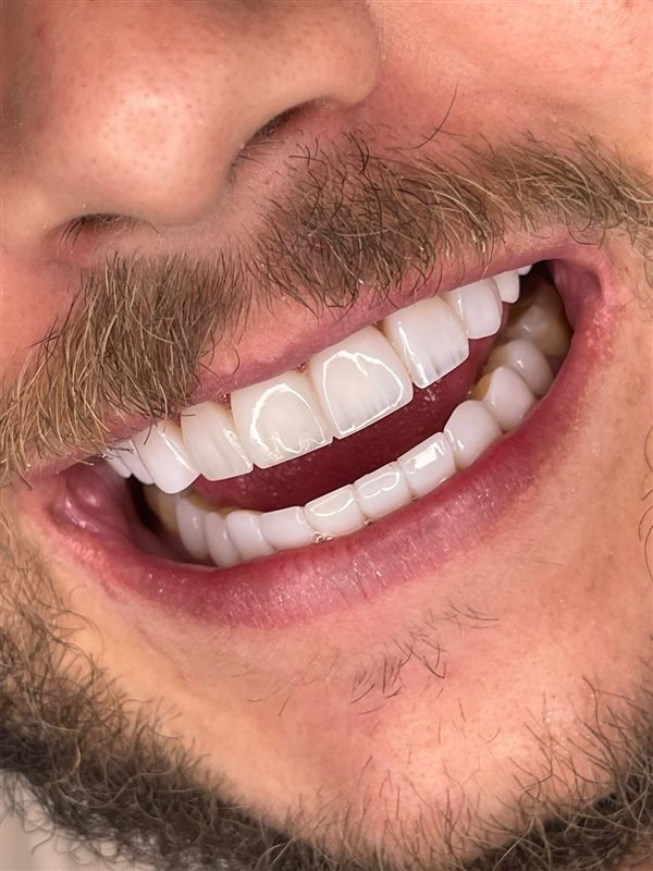 Sorriso com facetas — Vip Sorrisos Prime