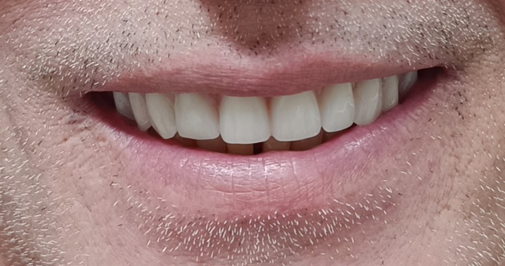 Sorriso reabilitado — resultado de tratamento na Vip Sorrisos Prime
